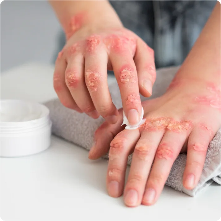 Psoriasis Treatments in McMinnville OR for Clearer, Healthier Skin