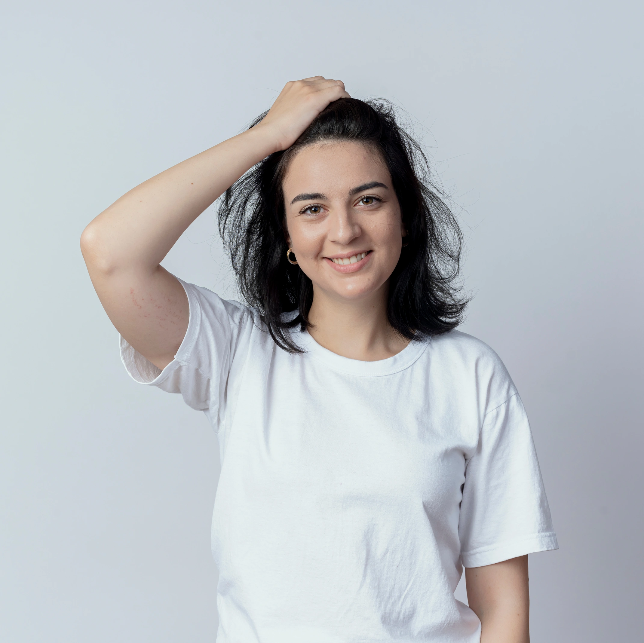 alopecia areata treatment