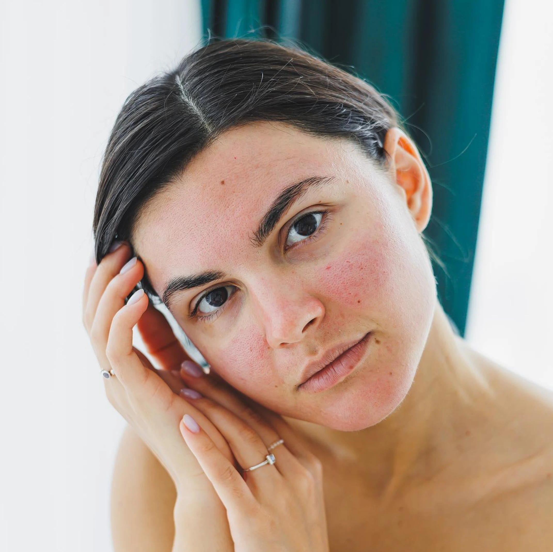 Eczema Treatment in McMinnville OR