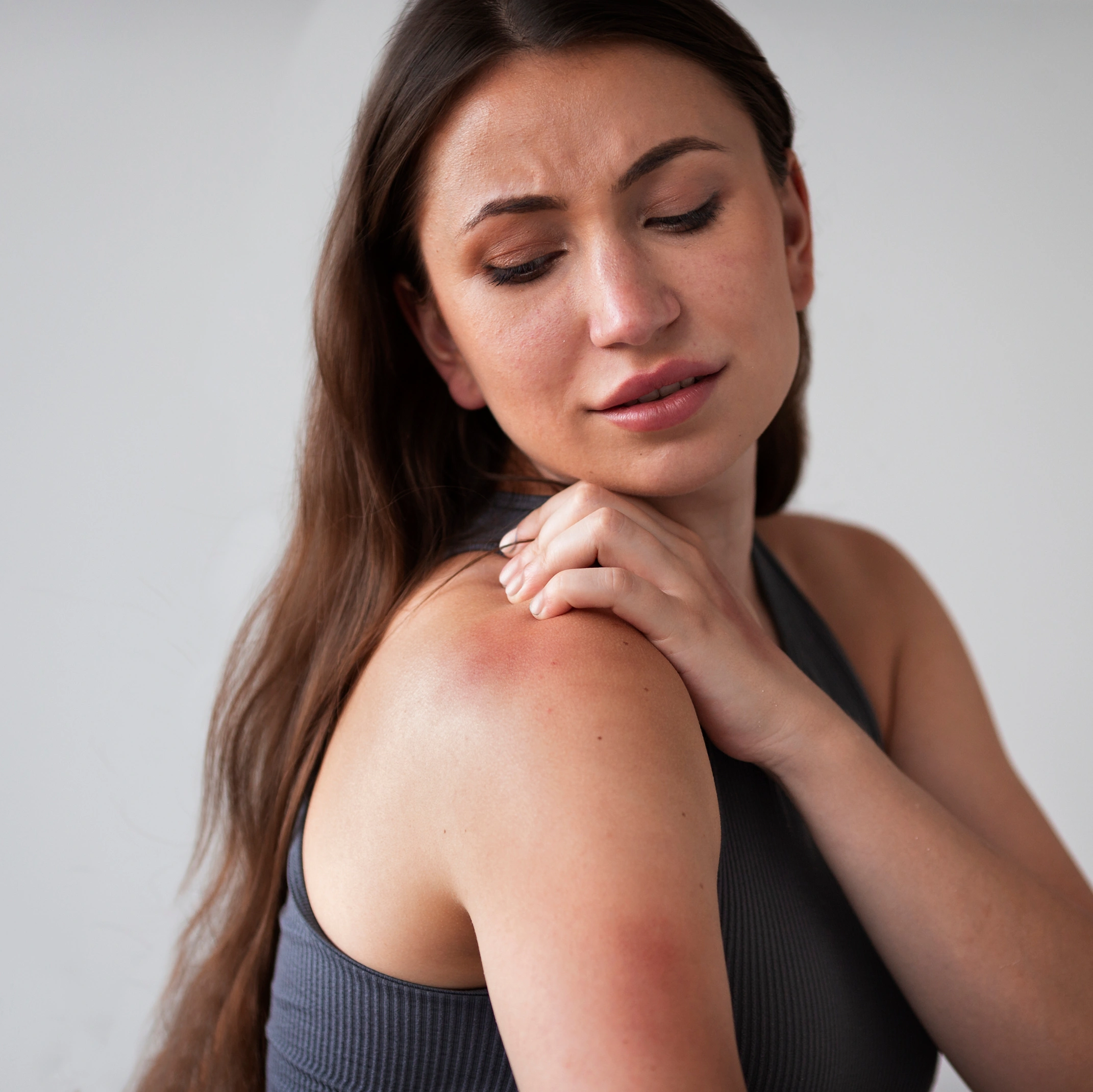 hives urticaria treatment