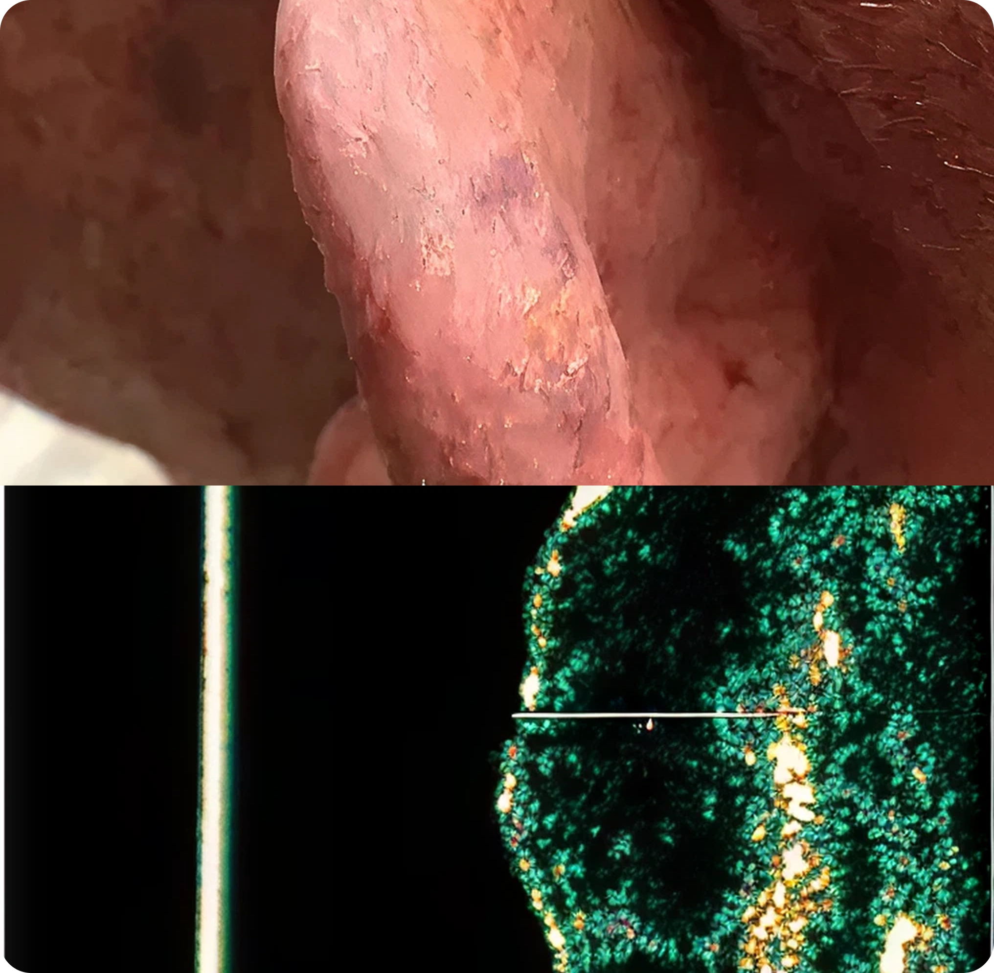 Superficial Radiation Therapy for Skin Cancer | Campbell Dermatology