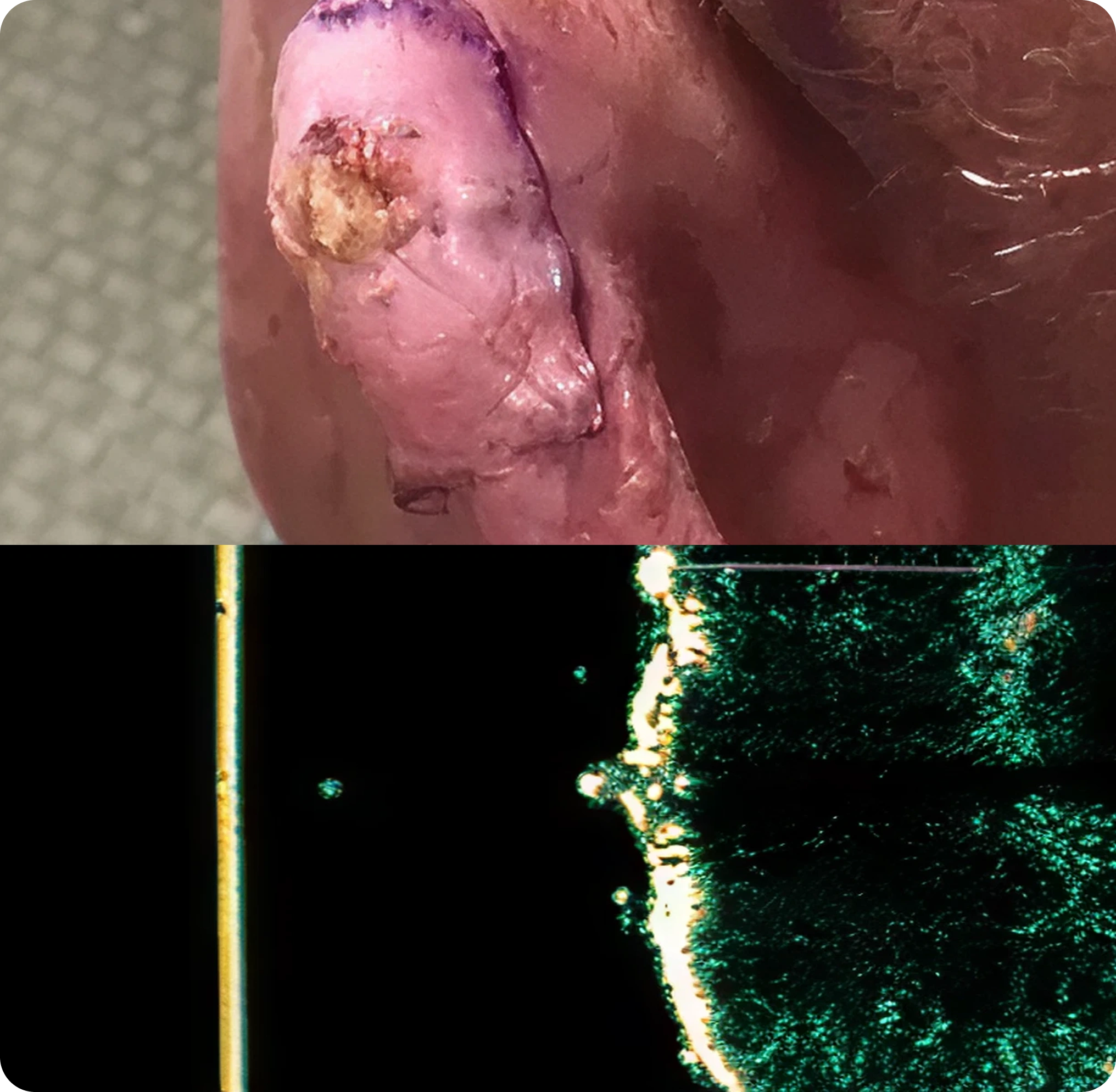 Superficial Radiation Therapy for Skin Cancer | Campbell Dermatology