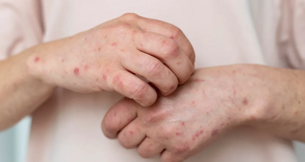 Seborrheic Dermatitis Treatment in McMinnville, OR | Expert Skin Care