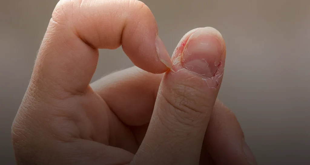 Ingrown nails Treatment in McMinnville