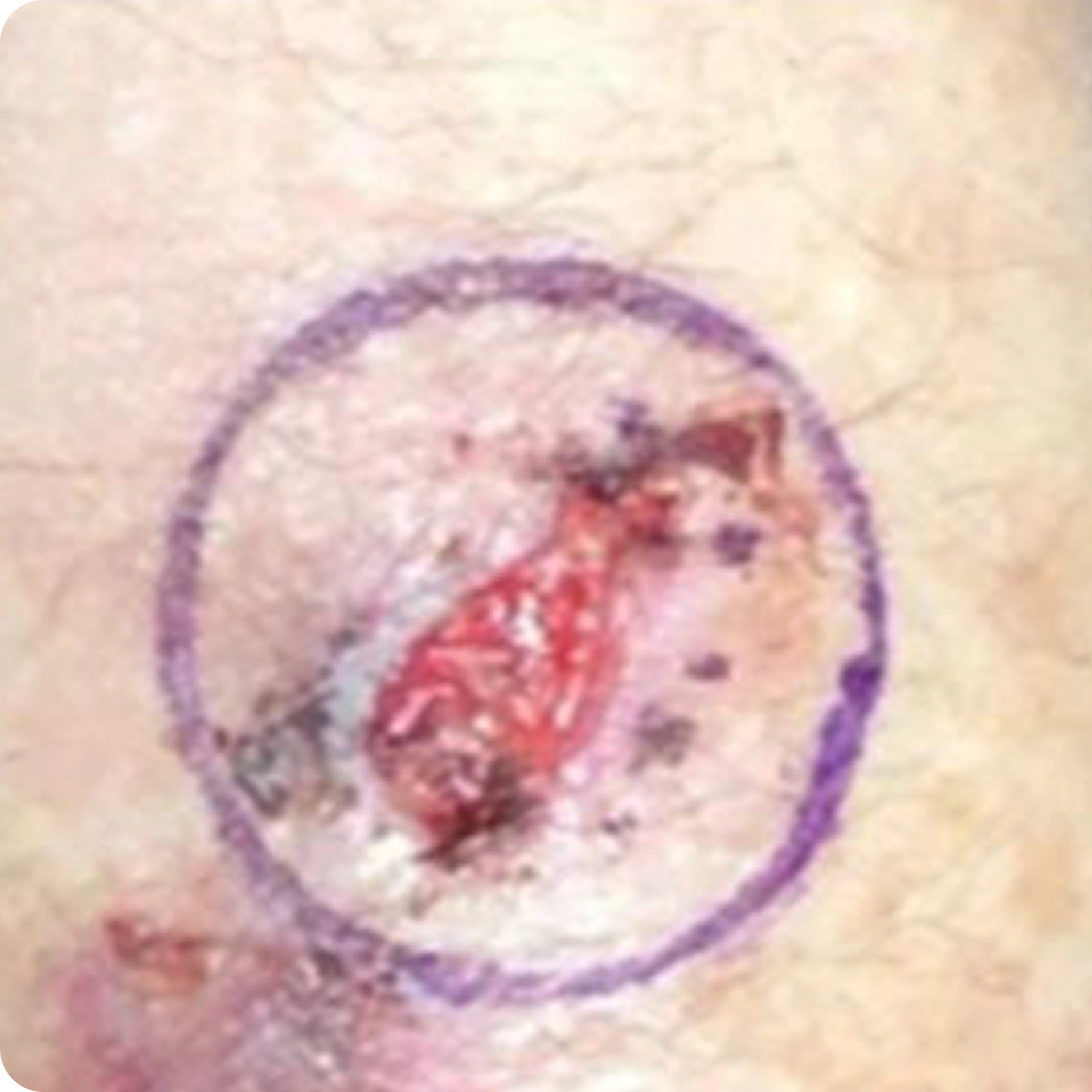 Superficial Radiation Therapy for Skin Cancer | Campbell Dermatology