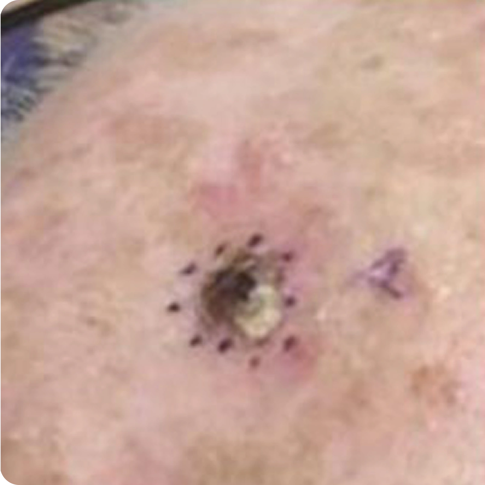 Superficial Radiation Therapy for Skin Cancer | Campbell Dermatology