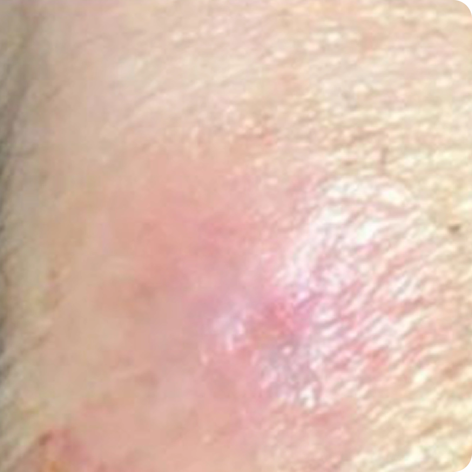 Superficial Radiation Therapy for Skin Cancer | Campbell Dermatology