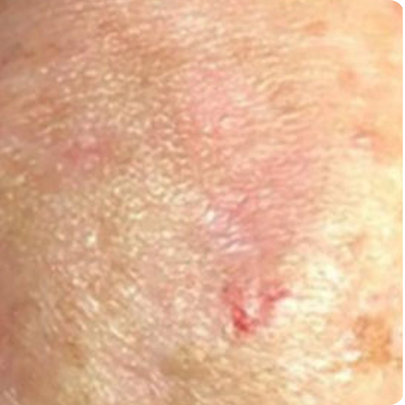 Superficial Radiation Therapy for Skin Cancer | Campbell Dermatology