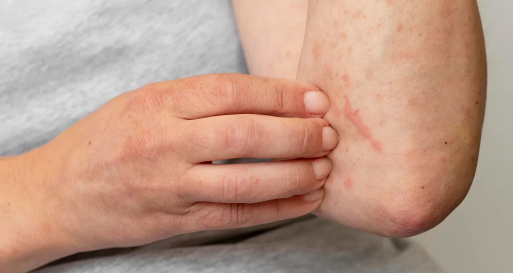 contact dermatitis treatments