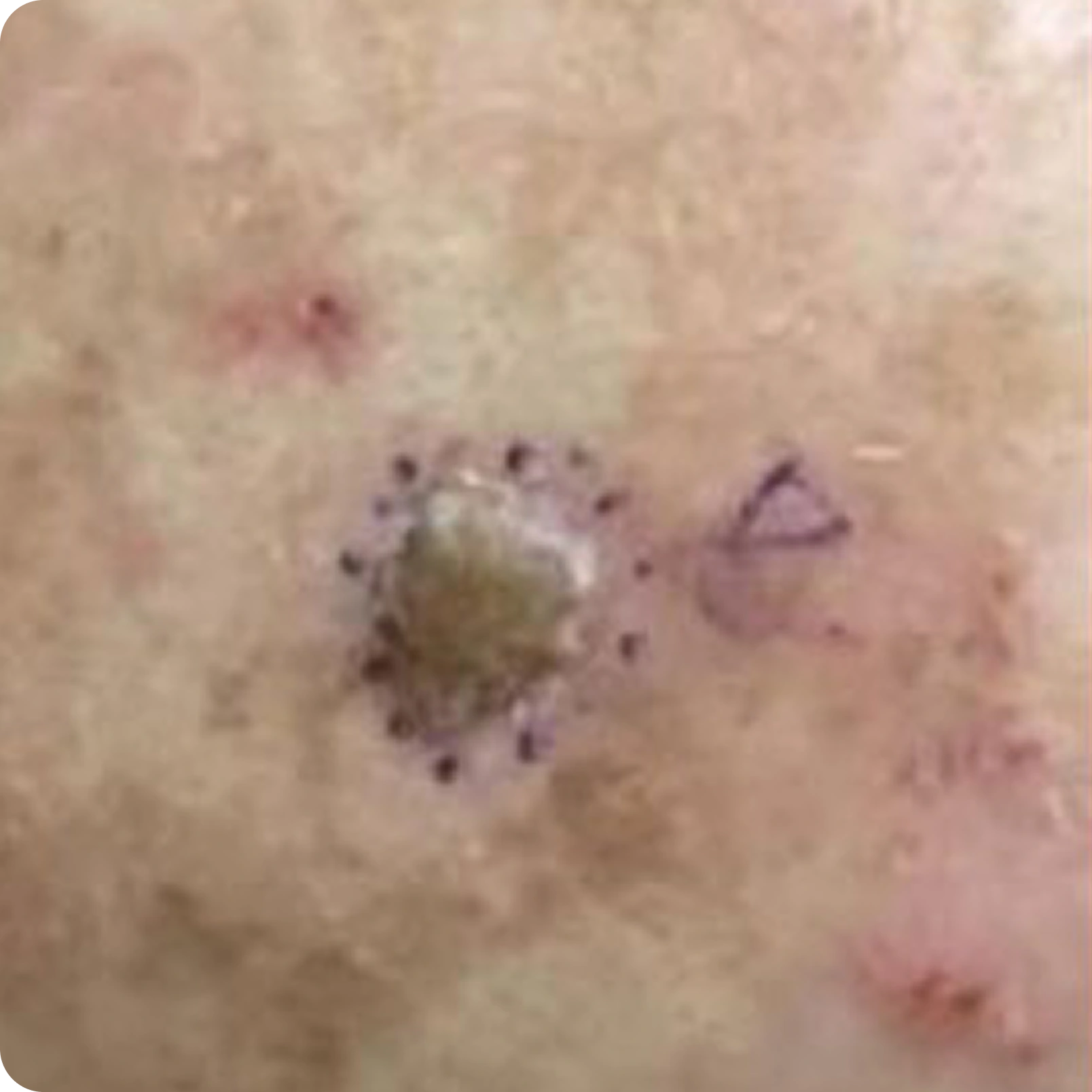 Superficial Radiation Therapy for Skin Cancer | Campbell Dermatology