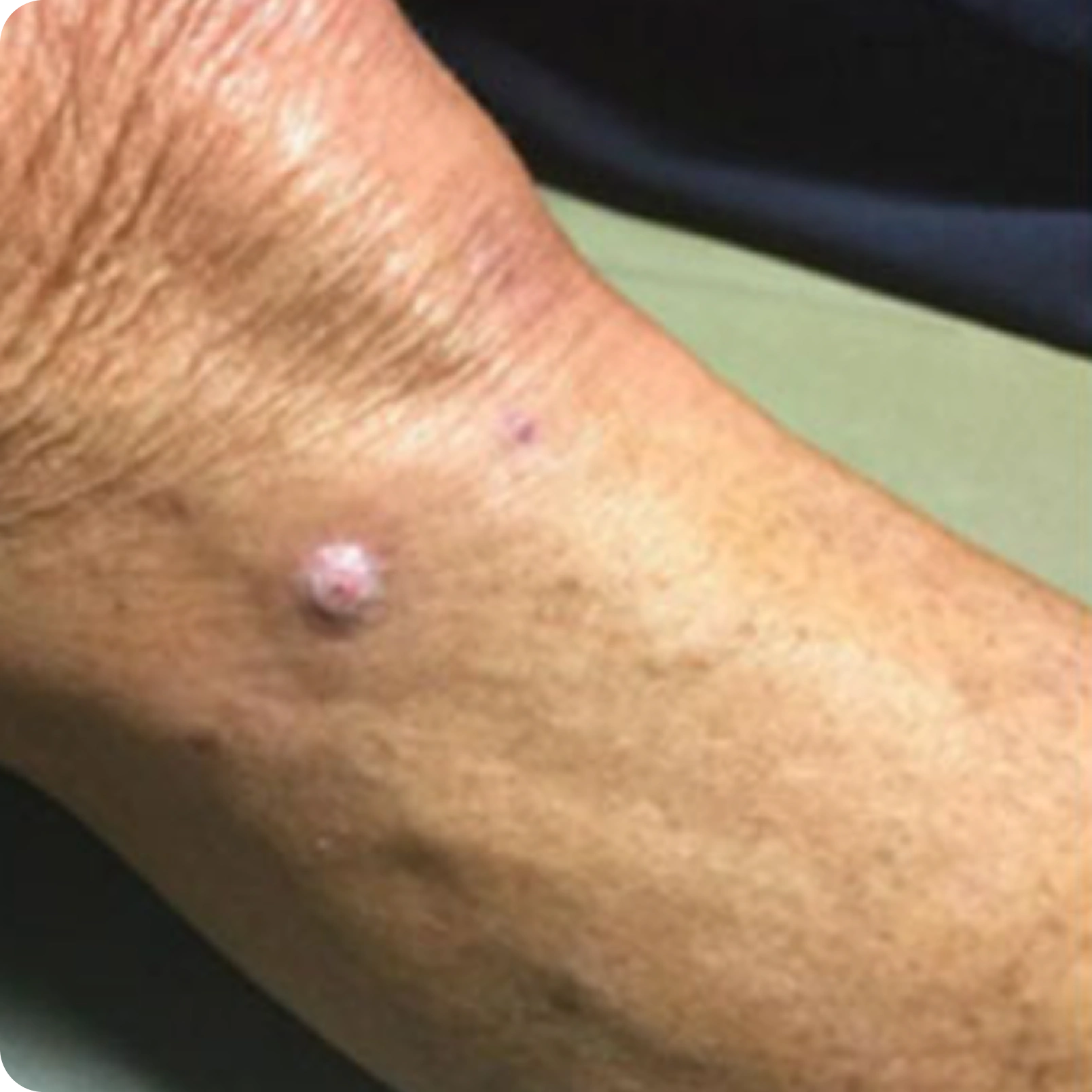 Superficial Radiation Therapy for Skin Cancer | Campbell Dermatology