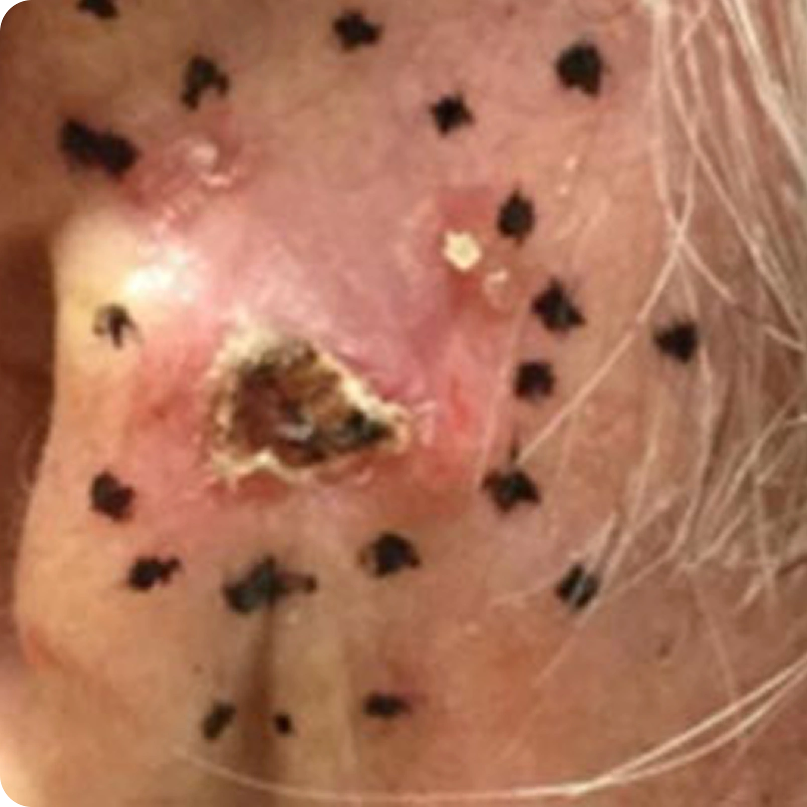 Superficial Radiation Therapy for Skin Cancer | Campbell Dermatology