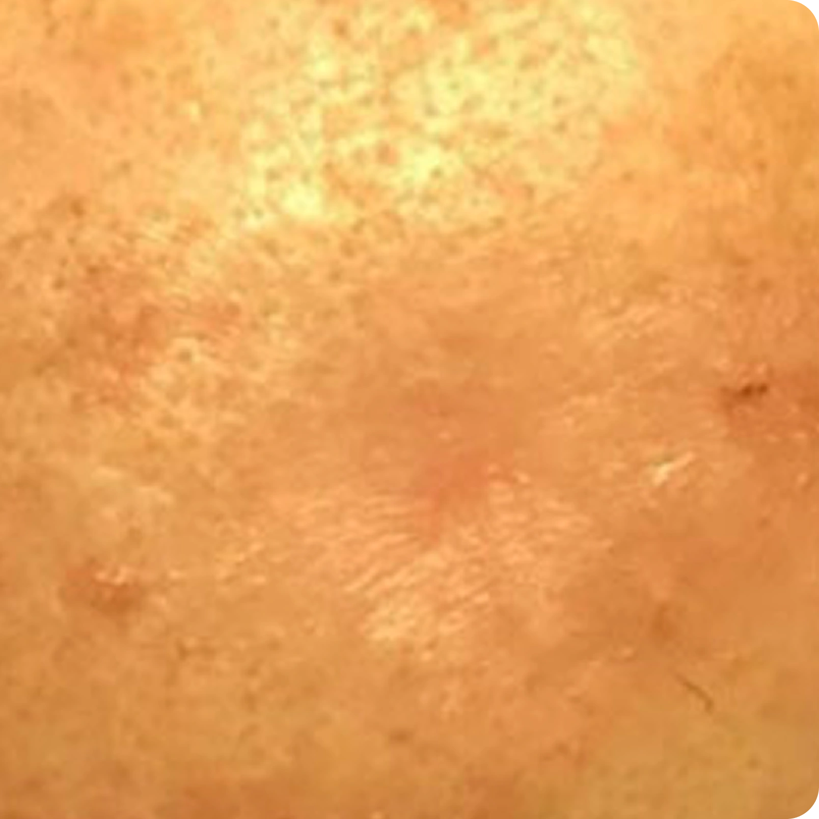 Superficial Radiation Therapy for Skin Cancer | Campbell Dermatology