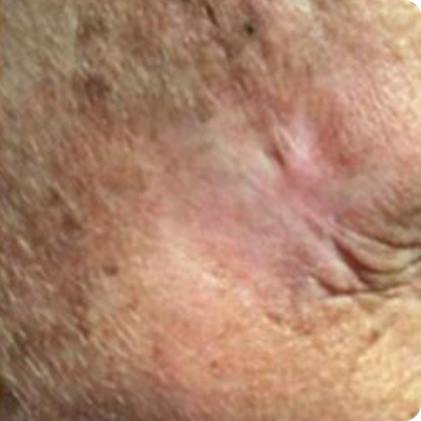 Superficial Radiation Therapy for Skin Cancer | Campbell Dermatology