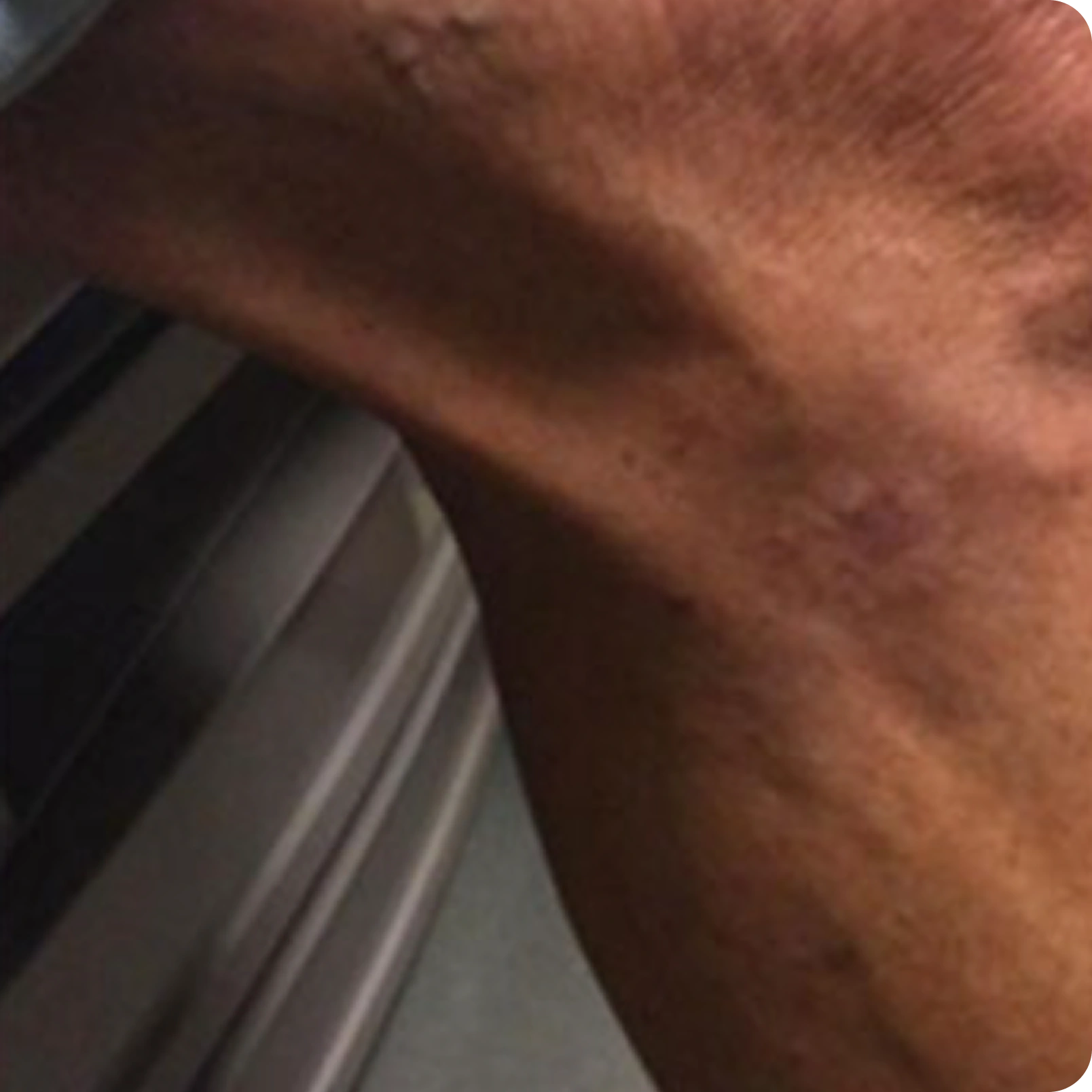 Superficial Radiation Therapy for Skin Cancer | Campbell Dermatology