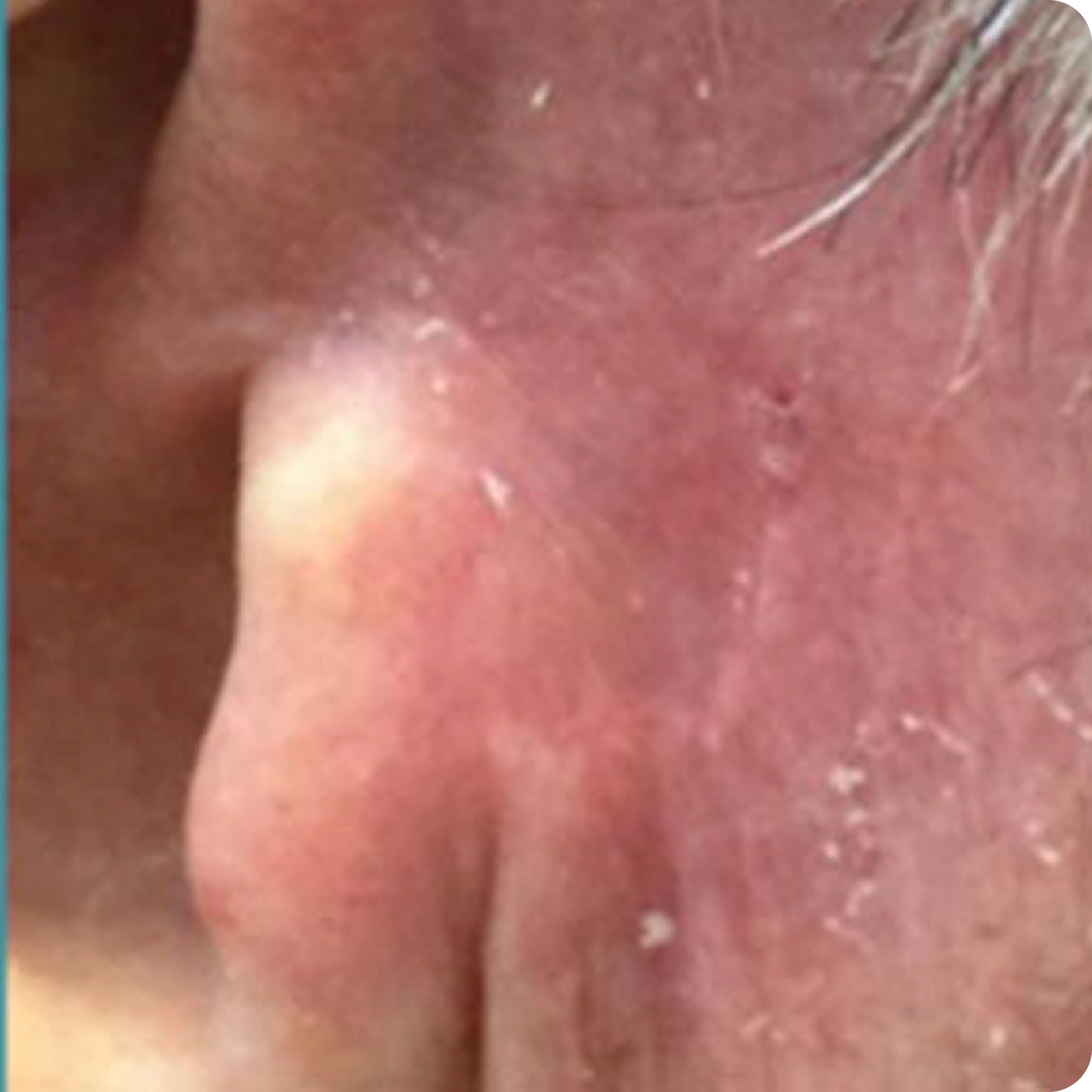 Superficial Radiation Therapy for Skin Cancer | Campbell Dermatology