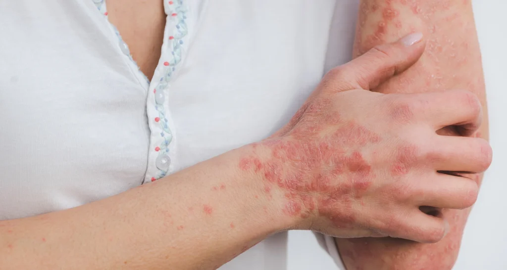 hives urticaria treatment