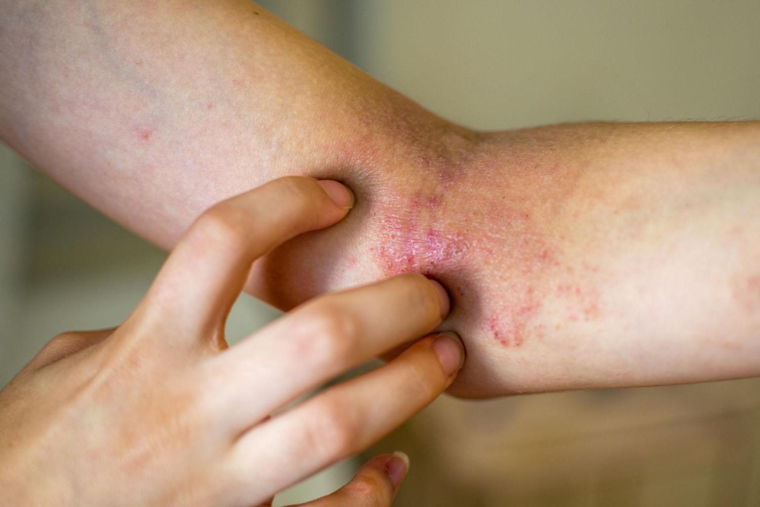 eczema flare-ups in adults
